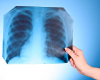 FC County Health Officials Confirm 3 Cases of Legionnaire